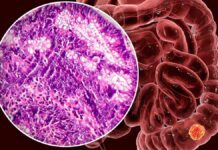 Estudio suizo detecta cáncer colorrectal mediante bacterias presentes en el intestino