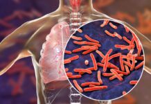 Las muertes por tuberculosis bajan un 3 % pero sigue siendo la infección más mortal