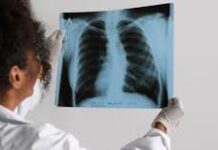 Analizan la relación entre los contaminantes del aire y los subtipos de cáncer de pulmón