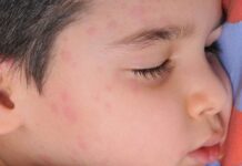 Alergias alimentarias infantiles: una combinación de factores aumenta el riesgo