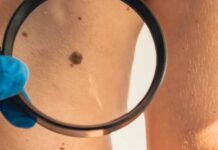 Cuba desarrolla tratamiento para el cáncer de piel, en medio de la crisis de medicamentos