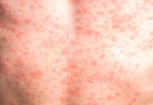 La OPS emite una alerta para aumentar la vacunación por el brote de sarampión en América